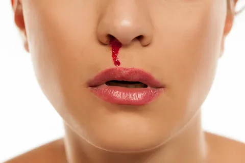 Nasenbluten bei Stress